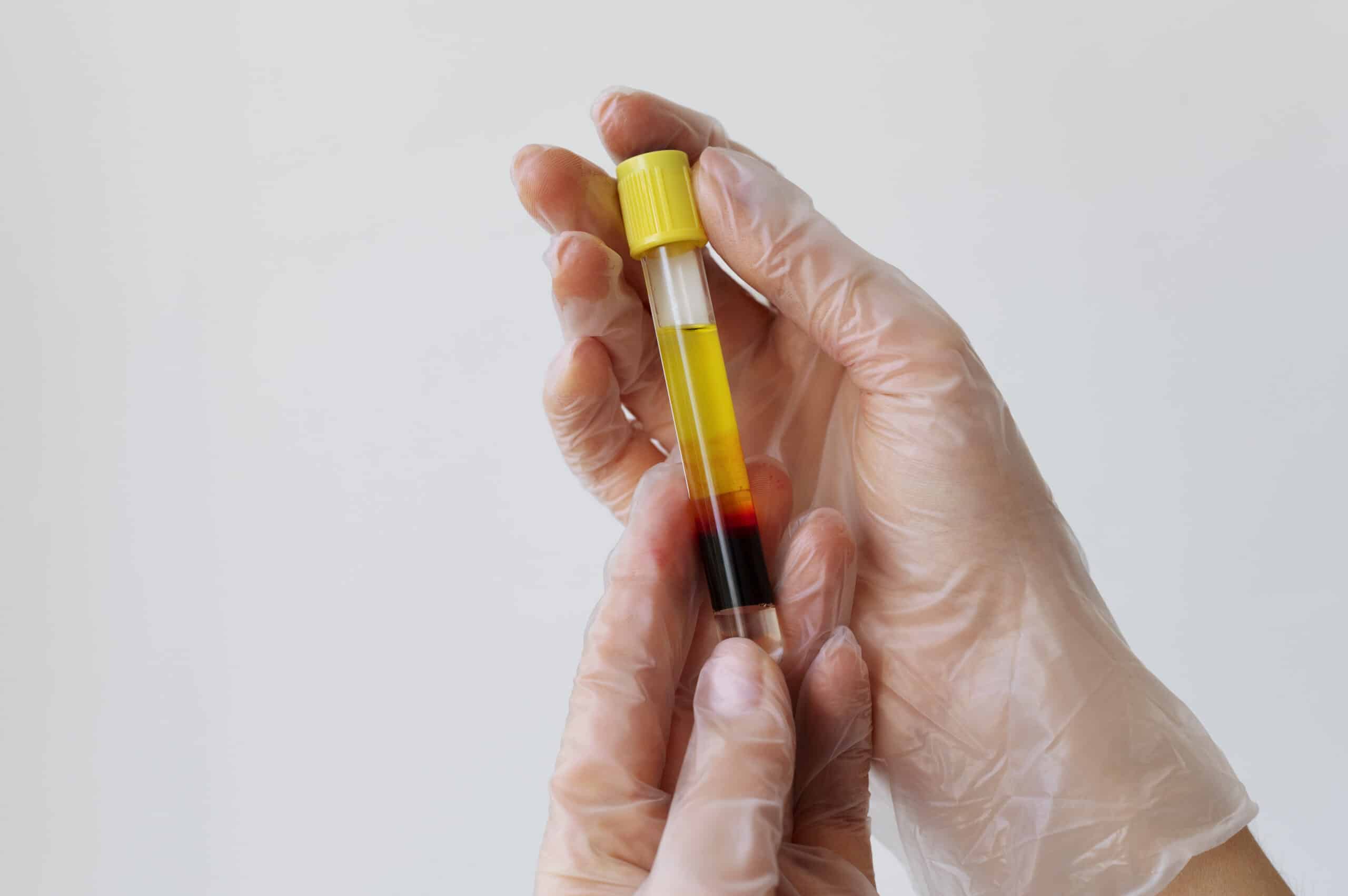 Mesoterapia capilar con fármacos